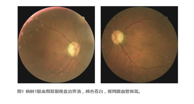 以假亂真——2例甲醇中毒性視神經(jīng)病變的臨床特征